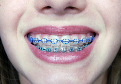 teeth straightening bands
