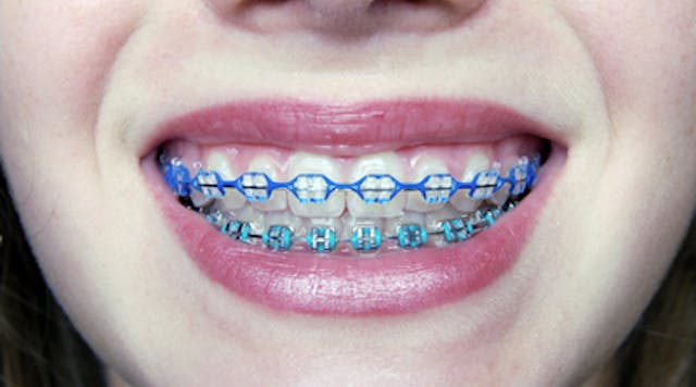 Are braces better than Invisalign? | Dentistry IQ