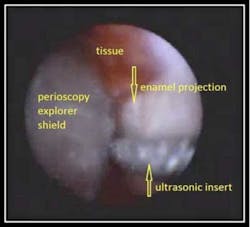 Enamel Projection Fo Enamel Projection Fo