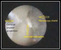 Enamel Resorption 3 Enamel Resorption 3