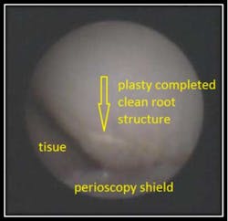 Enamoplasty Fo Enamoplasty Fo