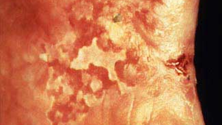 Erythroleukoplakia Fo
