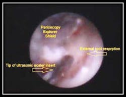 External Root Resorption Fo External Root Resorption Fo