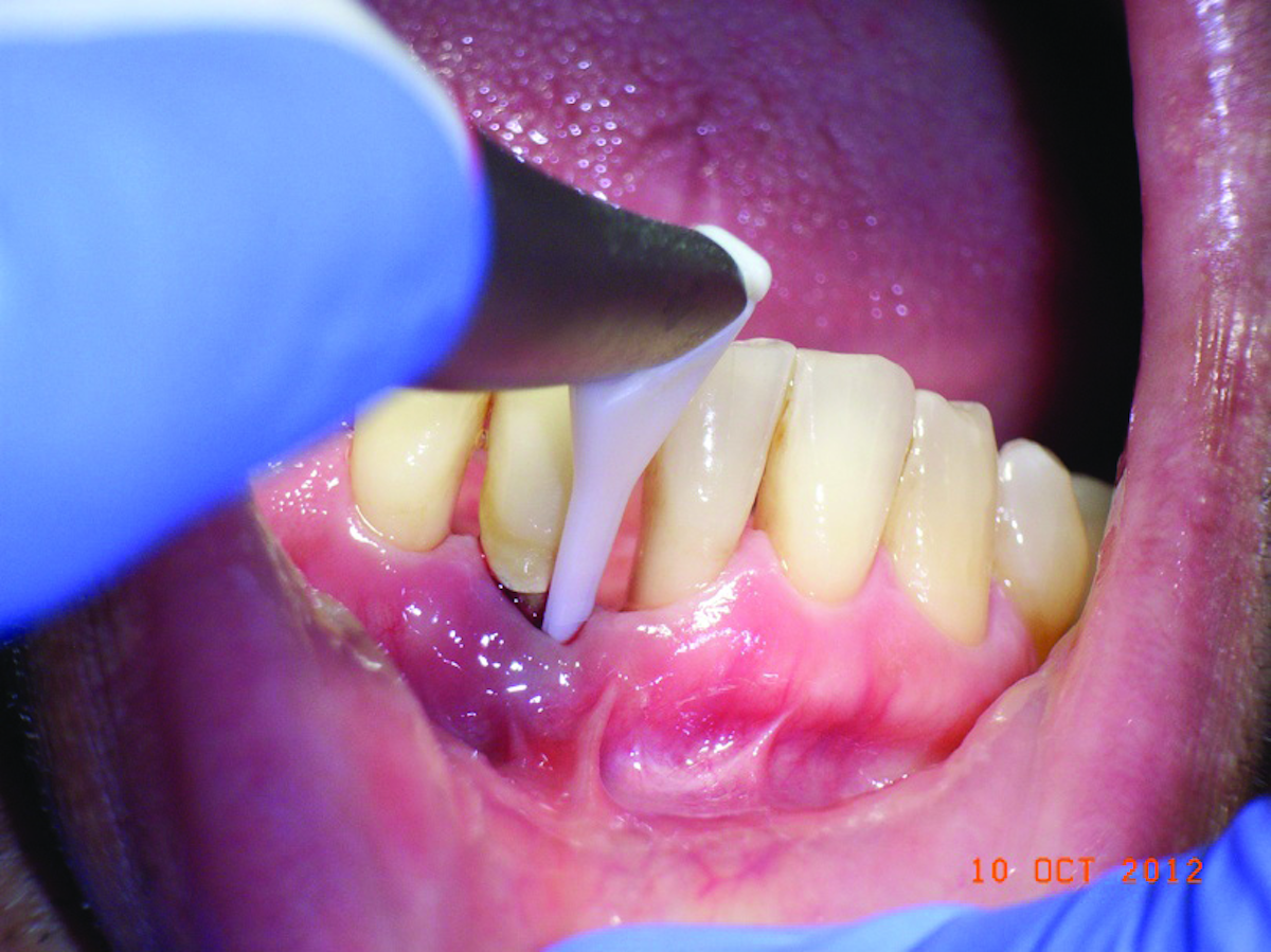 The necessity of subgingival air polishers | DentistryIQ