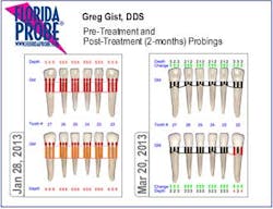 Gist Probings Perioprotect Gist Probings Perioprotect