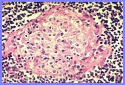 Granuloma Fo Granuloma Fo