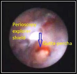 Gutta Percha Fo Gutta Percha Fo