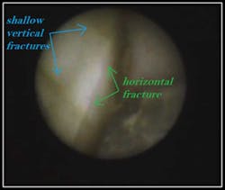 Hairline Vertical Fractures Fo Hairline Vertical Fractures Fo