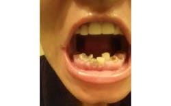 Heather Broken Teeth