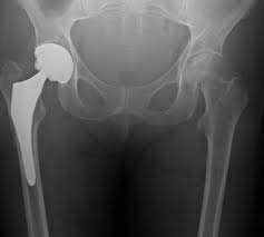 Hip Xray Fo
