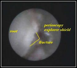 Horizontal Fracture Fo Horizontal Fracture Fo
