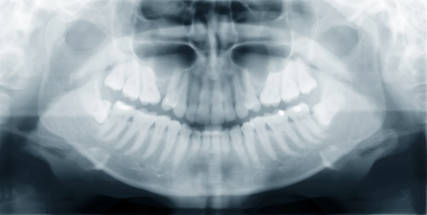 Update Osteonecrosis of the jaw (ONJ) DentistryIQ