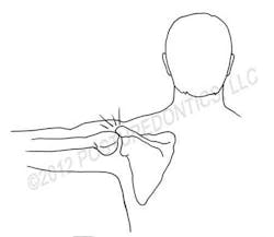 Impingement Fo Impingement Fo