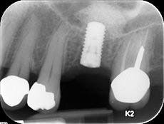 Implant Xray Fo Implant Xray Fo
