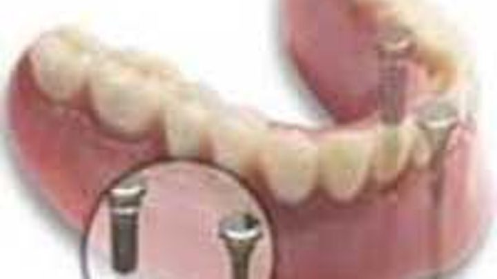Implants