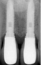 Implants Fo Implants Fo