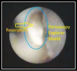 Interior Resorption 4 Interior Resorption 4