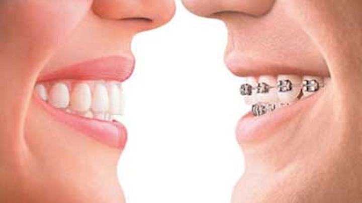 Invisalign Vs Braces Sadri