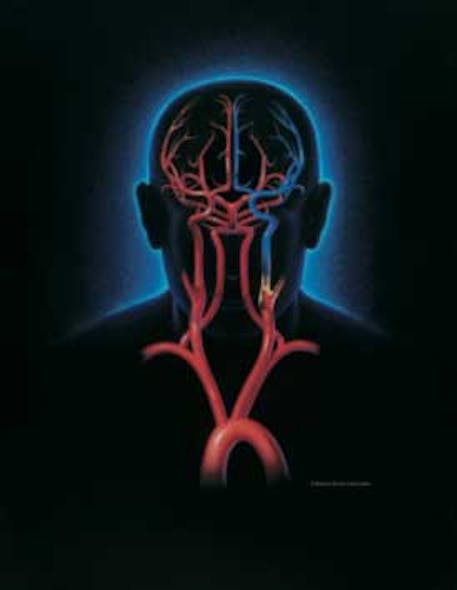 Ischemic Attack Fo