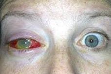 Jenn Lost Eye Jenn Lost Eye