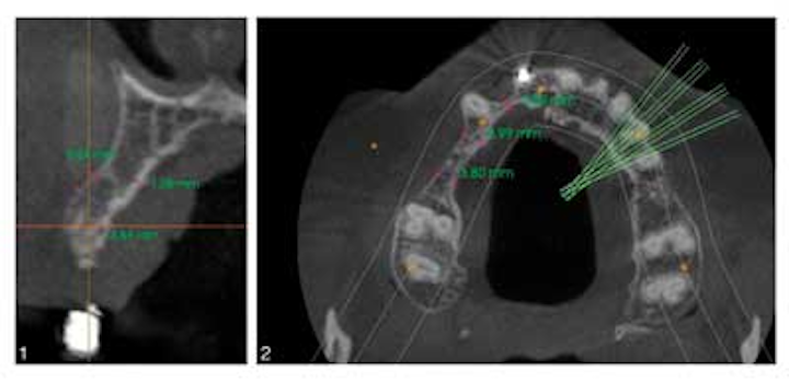 Joiridgesplitvsblockbonegraft