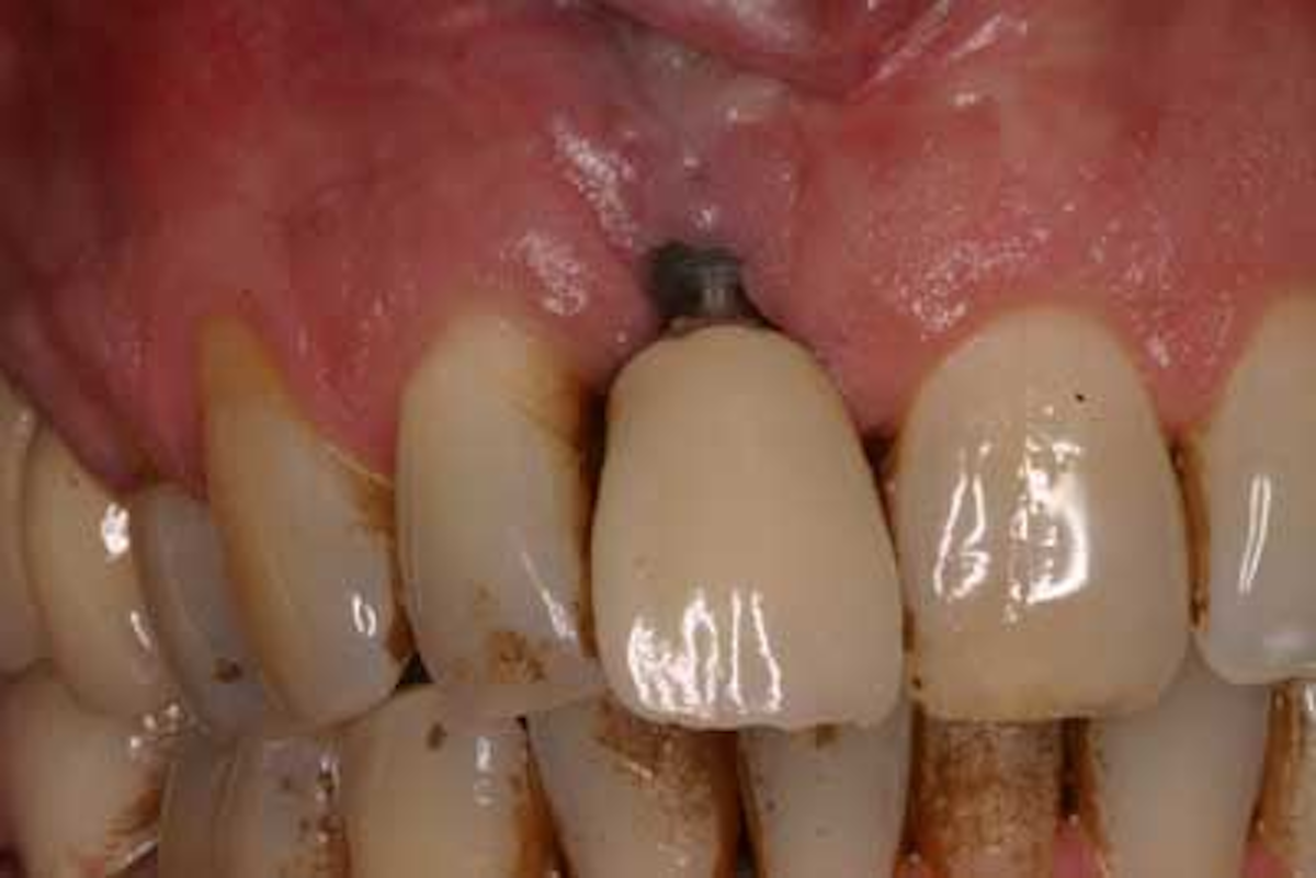 Creating keratinized soft tissue to enhance the implant restoration