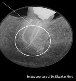 Kinra Curve Obturation Endo Kinra Curve Obturation Endo