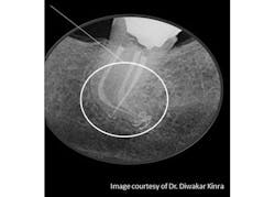 Kinra Obturation Curve Endo Kinra Obturation Curve Endo