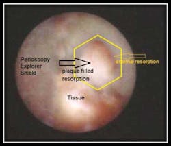 Lesion Ctg 1 Lesion Ctg 1
