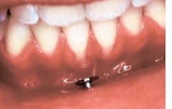 Lip Piercing Lip Piercing