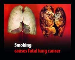 Lung Cancer Fo