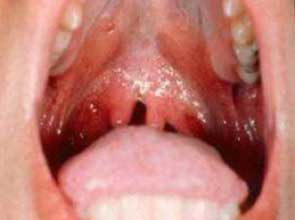 Hpv warts back of tongue Wart on tongue child