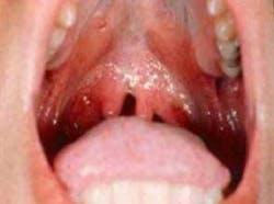 Malignancies Hpv Fo Malignancies Hpv Fo