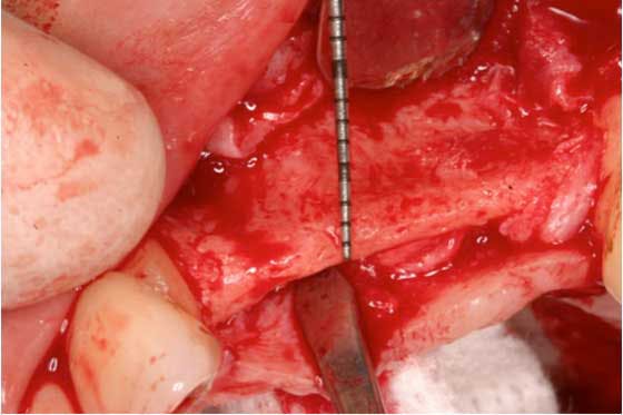 Mann Froum Maxillary Implant Restoration