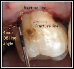 Mirror Resorption 1 Mirror Resorption 1