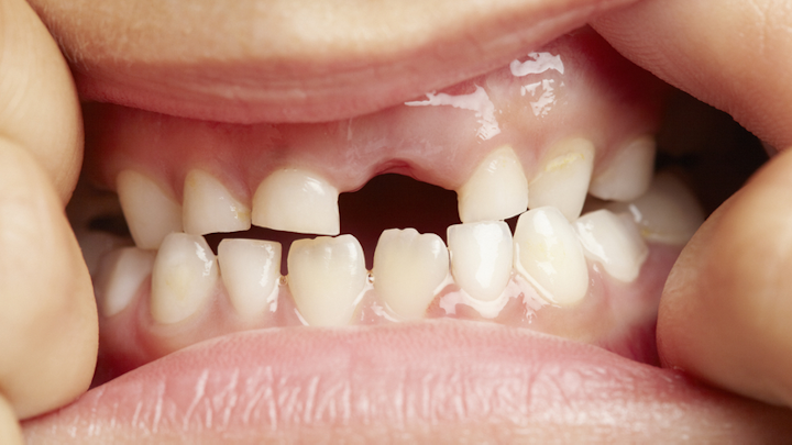 Missingtooth