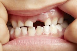 Missingtooth Missingtooth