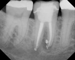 Mounceendoretreatpostopmay2013 Mounceendoretreatpostopmay2013