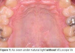 Mouthwithoutvelscopevxfig4a Mouthwithoutvelscopevxfig4a