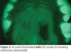 Mouthwithvelscopevxfig4b Mouthwithvelscopevxfig4b