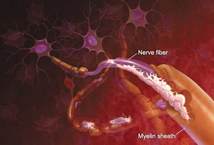 Ms Attacking Brain Fo