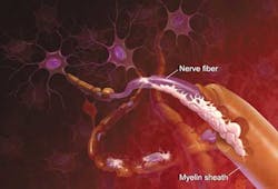 Ms Attacking Brain Fo Ms Attacking Brain Fo