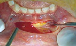 Mucosalincision Mucosalincision