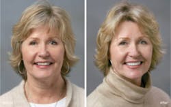 Nusimplicity Veneers Es Nusimplicity Veneers Es