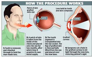 The Medical Facts: The Breakthrough 'TOOTH IN EYE' Surgery