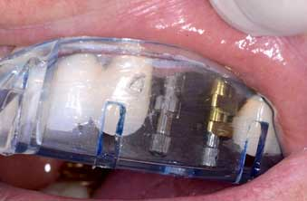 Using the open tray technique when impressing implant sites Dentistry IQ