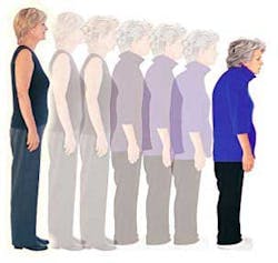 Osteoporosis Fo Osteoporosis Fo