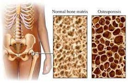 Osteoporosis Graphic Fo