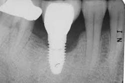 Peri Implantitis Peri Implantitis