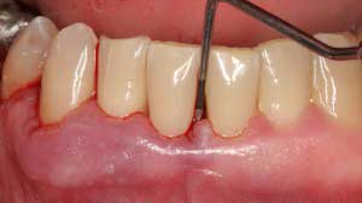 Perio Disease Fo